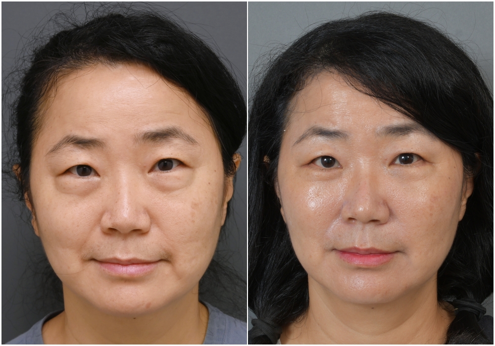 眼袋手術全記錄 | 我的眼袋終於變臥蠶！唯一後悔就是沒有更早做