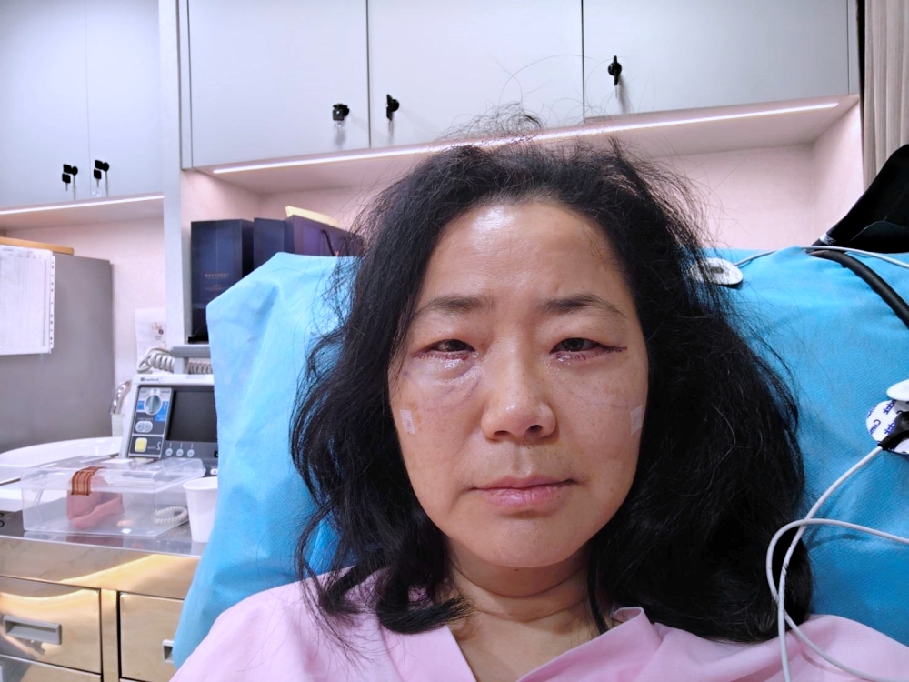 眼袋手術全記錄 | 我的眼袋終於變臥蠶！唯一後悔就是沒有更早做