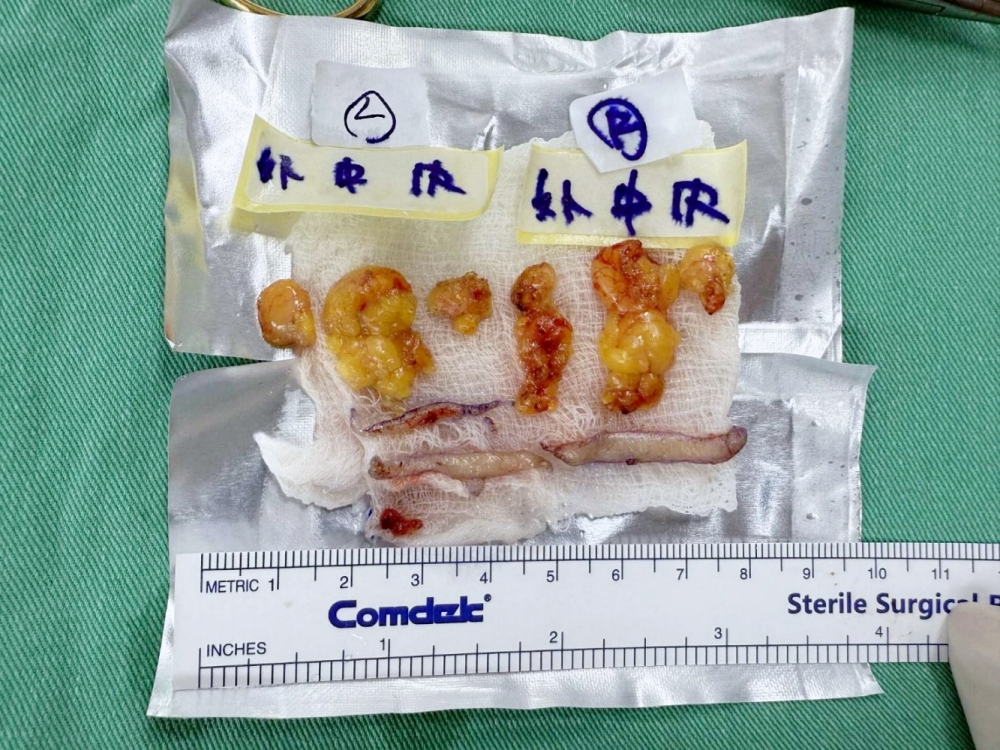 眼袋手術全記錄 | 我的眼袋終於變臥蠶！唯一後悔就是沒有更早做